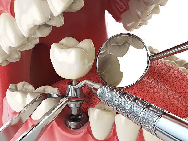 Best Emergency Root Canal Treatment in Ackerman, MS
