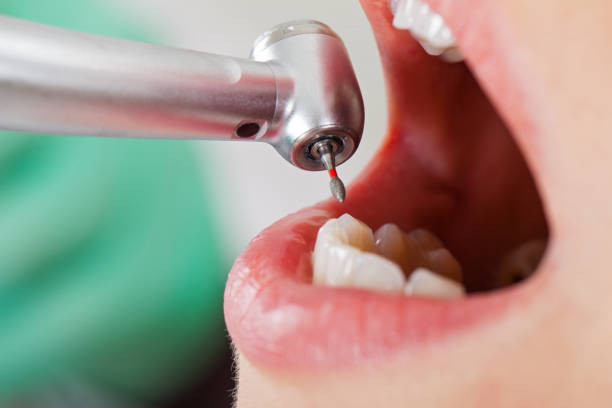 Best Emergency Tooth Extraction in Ackerman, MS